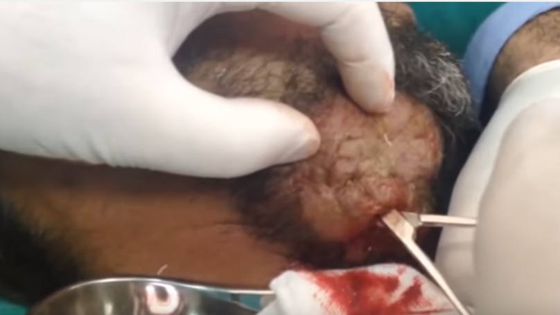 Doctor Pops the Most Disgusting Tennis Ball Sized Abscess You’ve Ever Seen