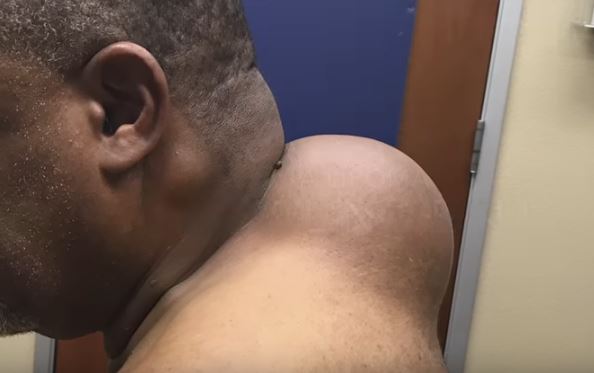 Man Gets Bowling Ball Sized Lipoma Removed By Dr Pimple Popper