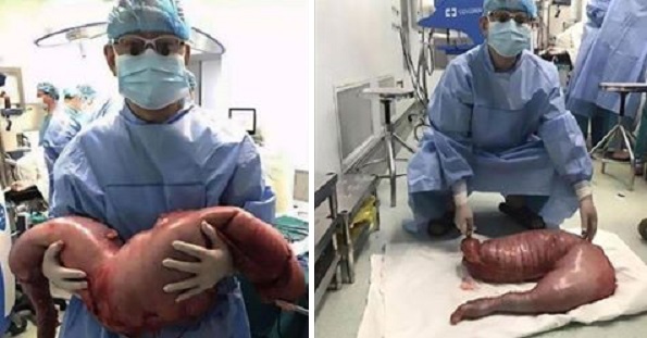 Surgeons Removed This From A Man Who Had Been Constipated For Years