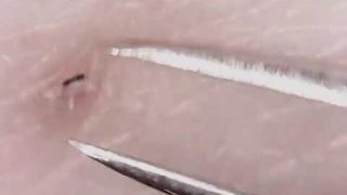 Extreme Close Ups of In-Grown Hair Removal Are Very “Satisfying”
