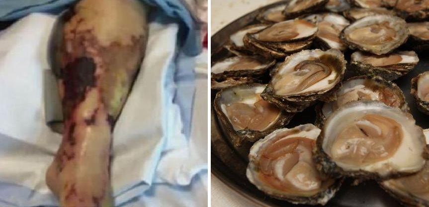 Woman Killed From Flesh-Eating Bacteria After Eating 24 Raw Oysters