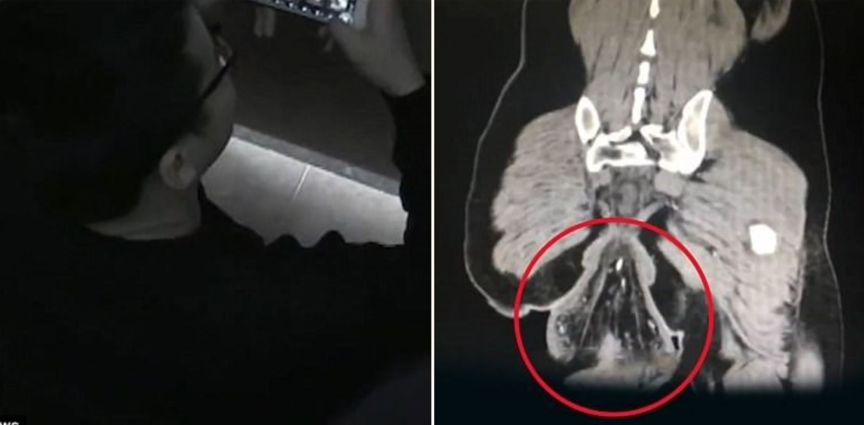 Man’s ass falls out after sitting on the toilet too long playing games on his phone