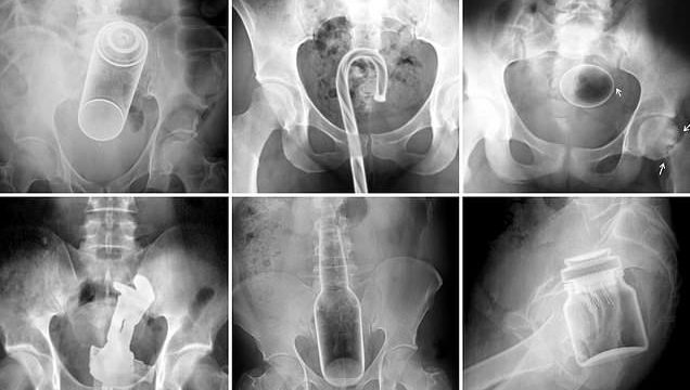 X-Rays reveal objects stuck in people’s orifices that required ER visits