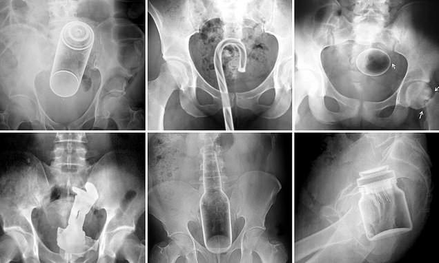 X-Rays reveal objects stuck in people’s orifices that required ER visits