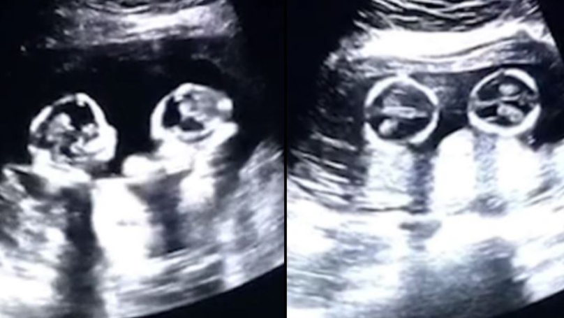 Identical twins spotted ‘fighting’ inside Mother’s womb