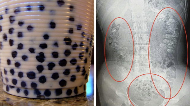 Teen in China allegedly has 100+ undigested bubble tea pearls inside her