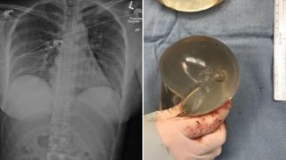 Sheila’s implant saves her life in what appears to be a medical first