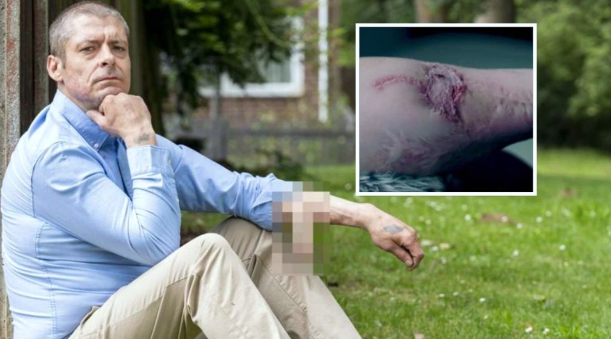 Bloke had a penis on his arm for six years!